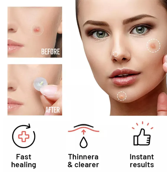Miracle Chin Acne Repair Patch Day & Night (36/72 Patch Box)